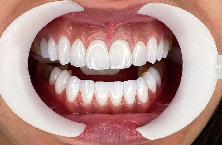 Smile Designing
